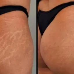 Rei da camuflagem 👙